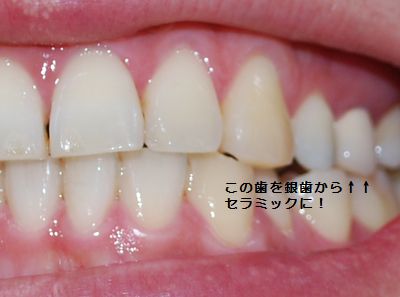 銀歯を白に パート2