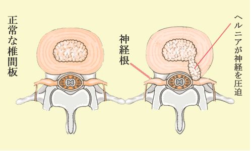 椎間板ヘルニア 状況