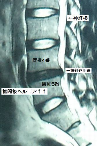 椎間板ヘルニア MRI写真拡大図