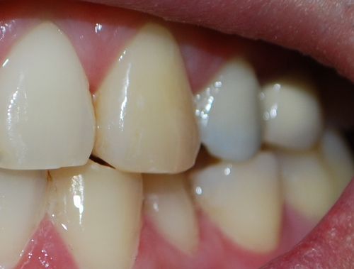 銀歯を白に パート5
