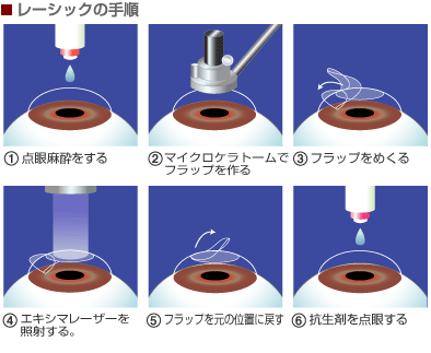 レーシックを検討する