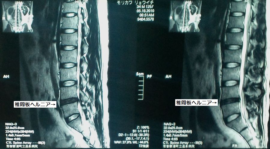 椎間板ヘルニア MRI写真