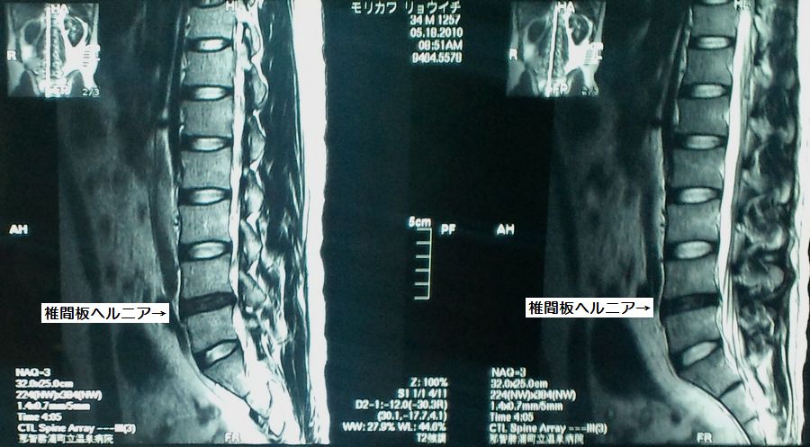 持病の椎間板ヘルニアが復活